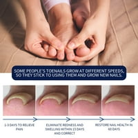Tekućina za ublažavanje paronihije, sredstvo za ublažavanje umora noktiju na nogama najbolji lijek za ublažavanje umora noktiju,